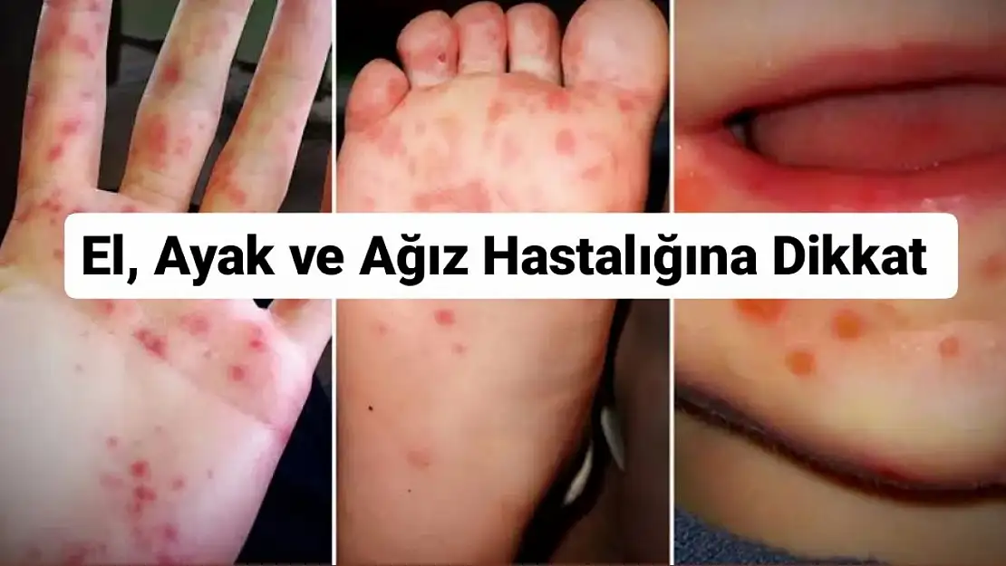 El, ayak ve ağız hastalığına dikkat