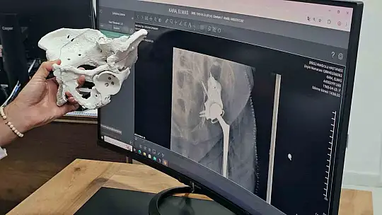 60 yaşındaki kadın 3D yazıcıyla üretilen kalça proteziyle sağlığına kavuştu