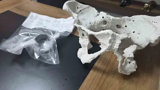 60 yaşındaki kadın 3D yazıcıyla üretilen kalça proteziyle sağlığına kavuştu