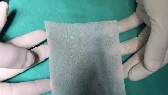 Ayağı kesilmek üzere olan emekli madenci, çözünebilir deri ile sağlığına kavuştu