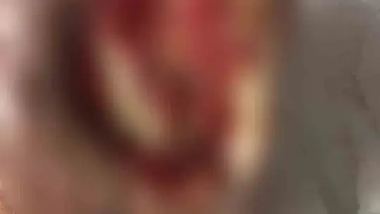 Ayağı kesilmek üzere olan emekli madenci, çözünebilir deri ile sağlığına kavuştu