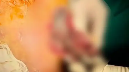 Ayağı kesilmek üzere olan emekli madenci, çözünebilir deri ile sağlığına kavuştu