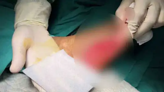 Ayağı kesilmek üzere olan emekli madenci, çözünebilir deri ile sağlığına kavuştu