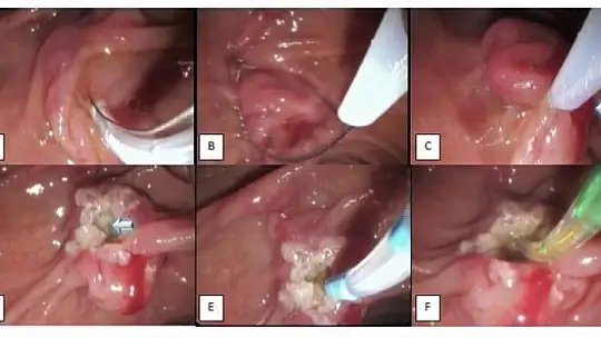 Gastroenteroloji kliniğinden bir ilk daha