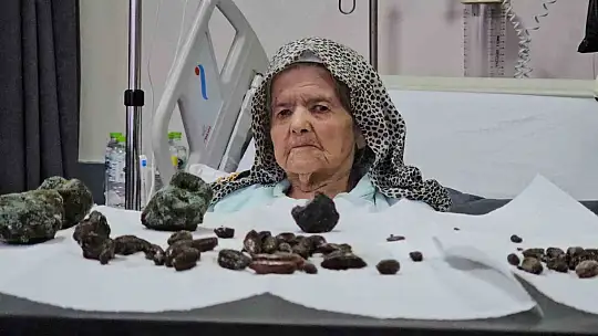 Görenler şok oldu: 92 yaşındaki kadının midesinden ve bağırsaklarından 35 zeytin, 28 hurma çekirdeği ile 5 taş çıktı