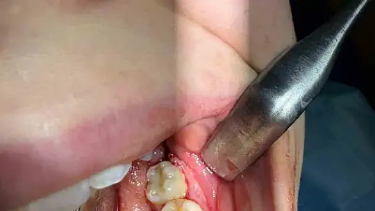 Karabük'te 16 yaşındaki hastaya doğal diş nakli yapıldı