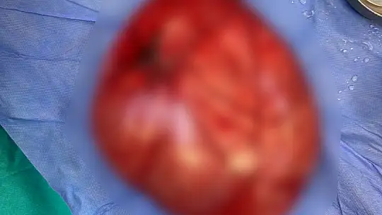 Kilo vermek için hastaneye giden çocuğun karnından 3,5 kiloluk kist çıktı