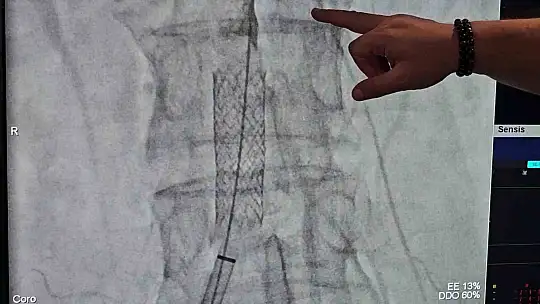 Milyonda bir görülen vaka: Öksürürken kalp damarı yırtılan kadın ölümden döndü