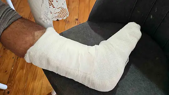 Sokak köpeğinin saldırısına uğradı, ayağı iki yerden kırıldı