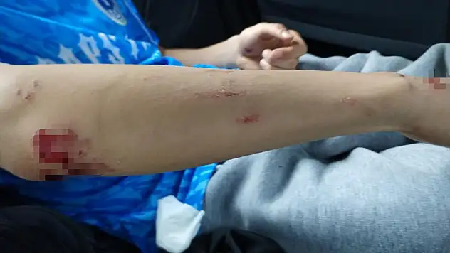 Sahipsiz köpeklerin saldırdığı çocuk hastanelik oldu