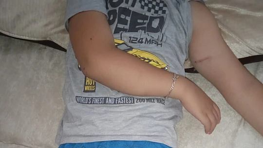 Sokak köpeklerinin saldırdığı çocuk babası sayesinde kurtuldu