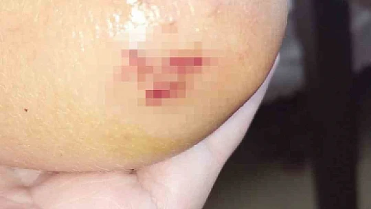 Sokak köpeklerinin saldırdığı çocuk babası sayesinde kurtuldu